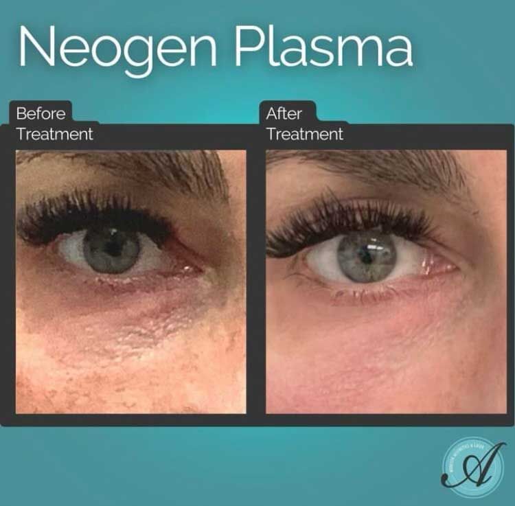 NeoGen Plasma Eyelift