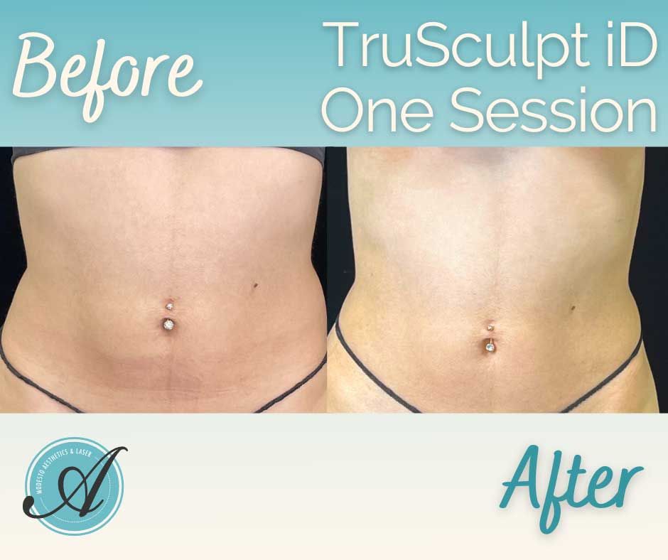 TruSculpt iD Before and After.
