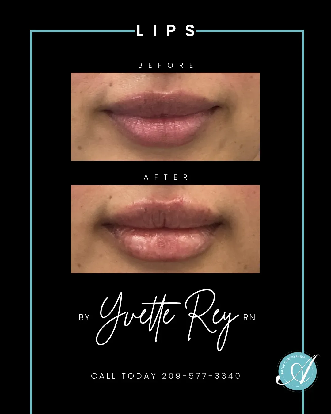 Lips before and after.