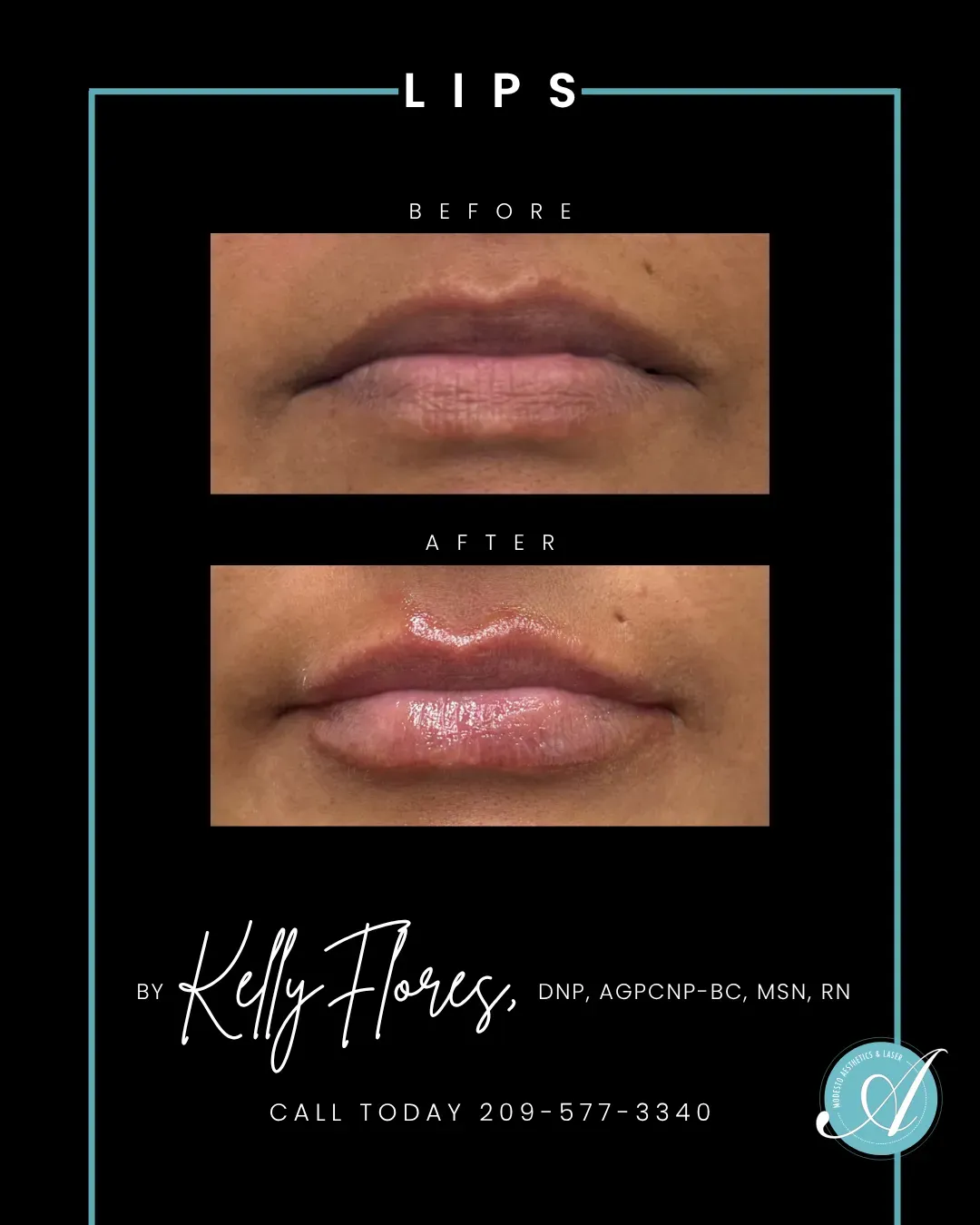 Lips before and after.