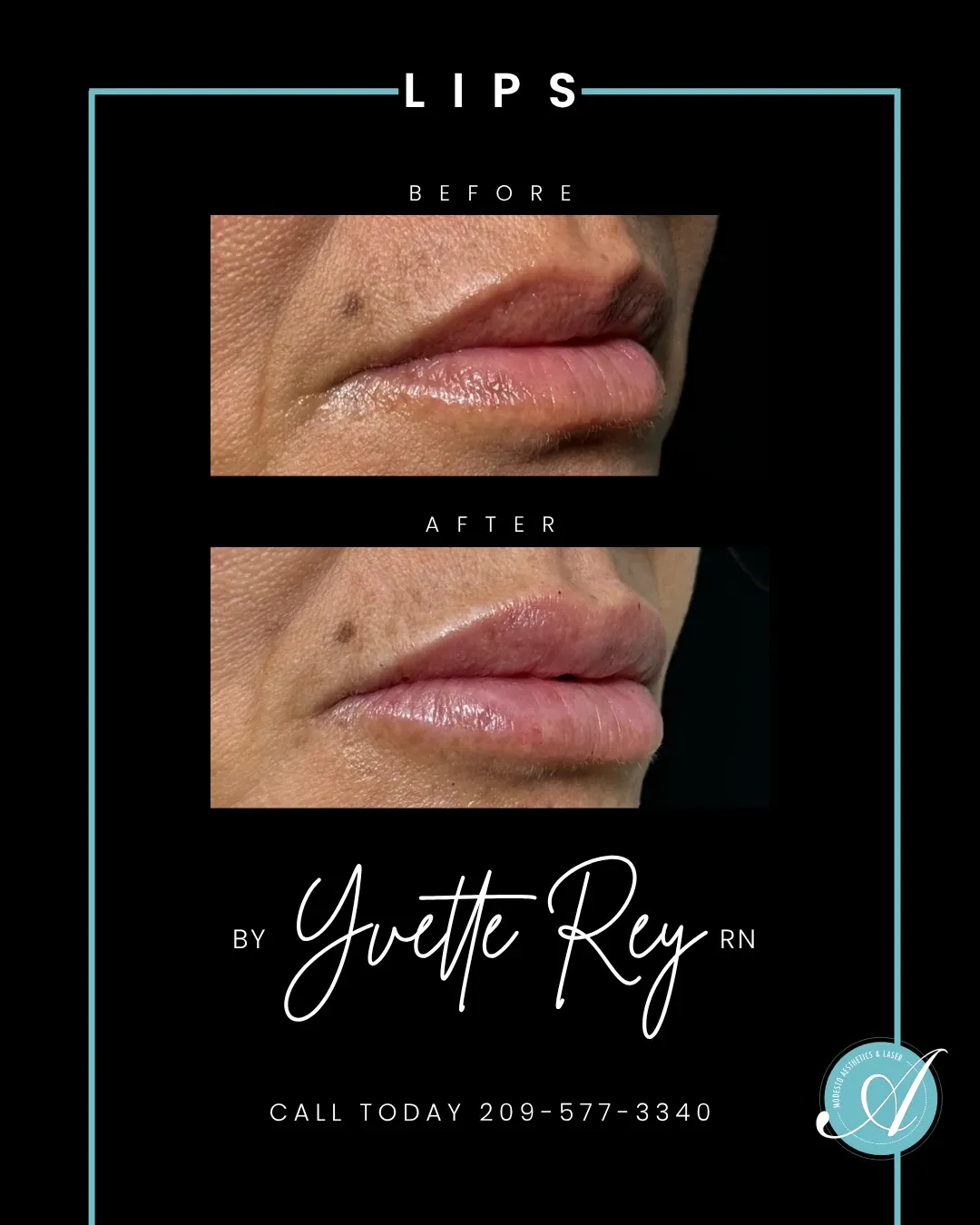 Lips before and after.