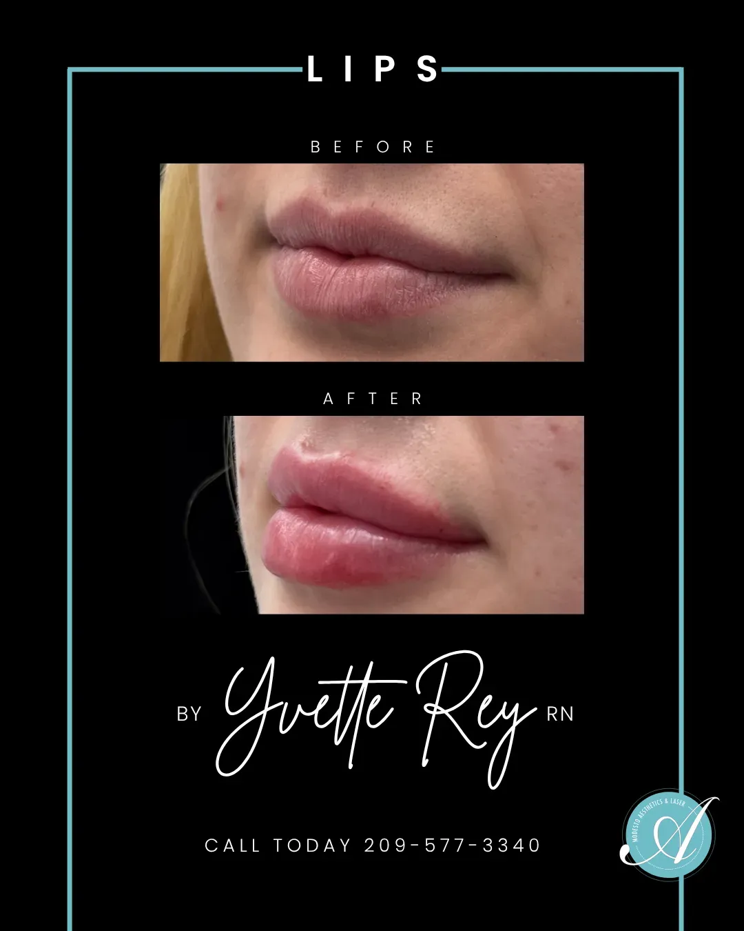Lips before and after.