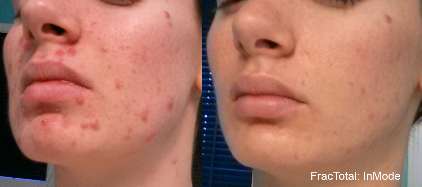 The GameChanging Treatment Morpheus8 Modesto Aesthetics & Laser