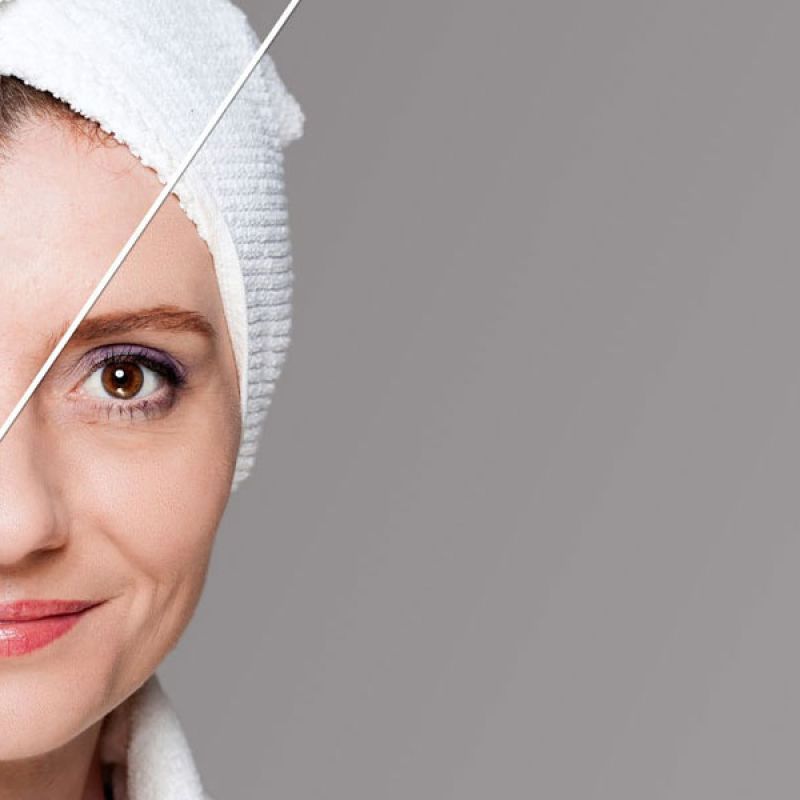 PRP/Microneedling