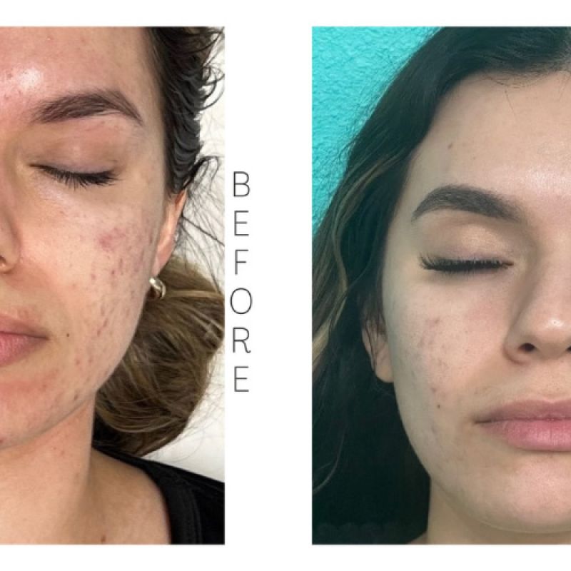 Spectra MDF Resurfacing