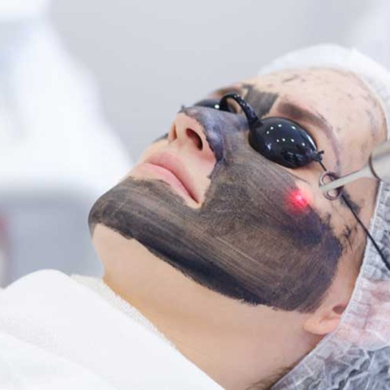 Hollywood Laser Peel